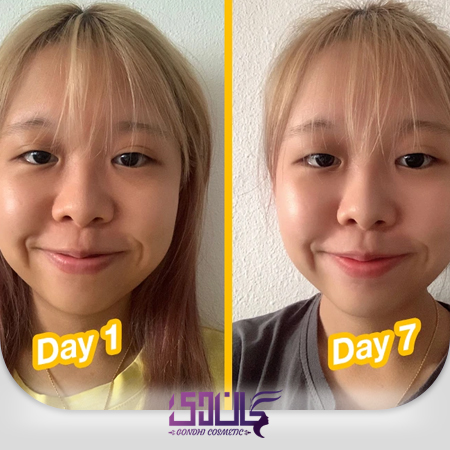 قبل و بعد از استفاده سرم صورت گارنیر
