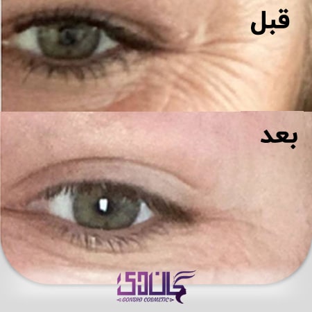 قبل و بعد از استفاده کرم دور چشم All About Eyes کلینیک حجم 15ML