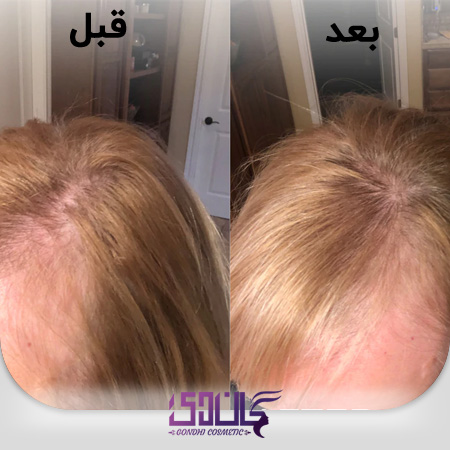 قبل و بعد از استفاده قرص تقویت کننده مو هیرتامین (Hairtamin Advanced)