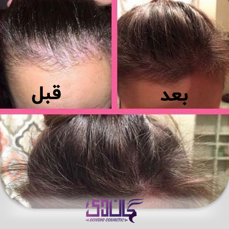 اثرات قرص هیرتامین در کمک به رشد و تقویت مو و ریزش مو قبل و بعد